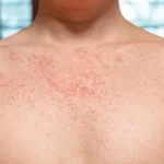Measles, Auckland, Health New Zealand, quarantine Period,