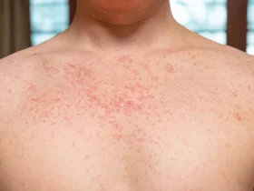 Measles, Auckland, Health New Zealand, quarantine Period,