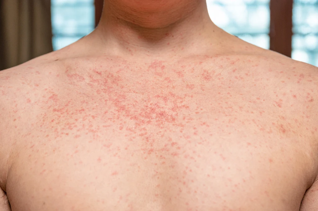 Measles, Auckland, Health New Zealand, quarantine Period,
